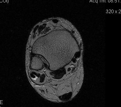 Peroneal Tendonitis